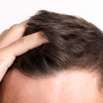 Przeszczep włosów - dlaczego jest konieczny?