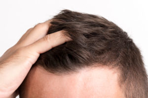 Przeszczep włosów - dlaczego jest konieczny?